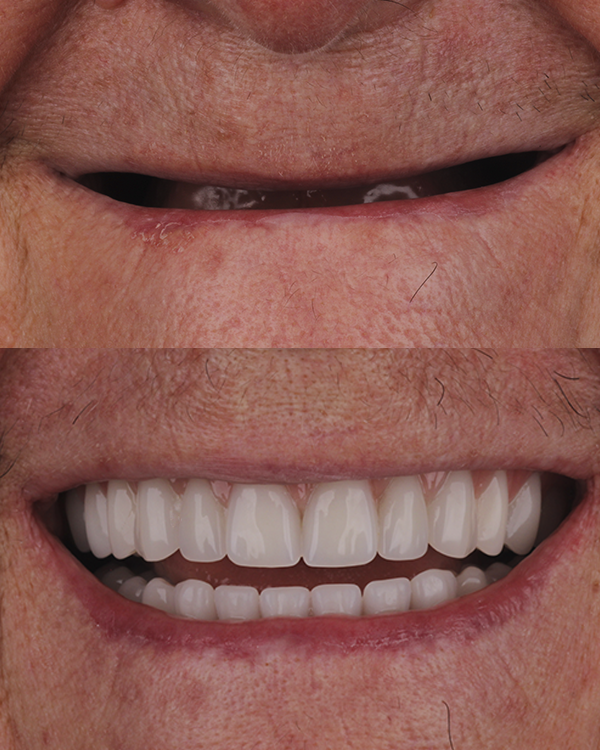 Implantes Dentários