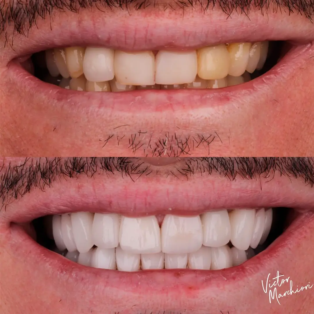 Caso 02 de lente de porcelana