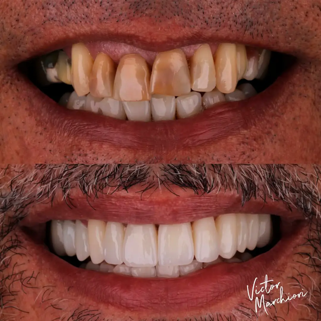 Caso 01 de lente de porcelana